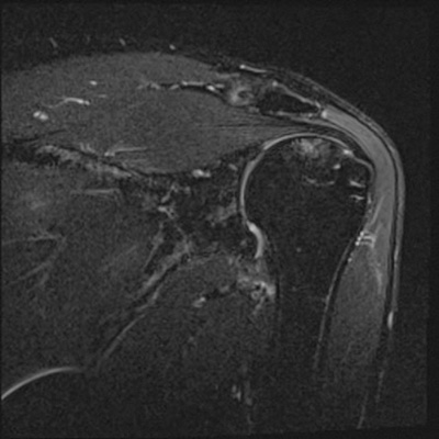 肩関節の冠状断脂肪抑制画像