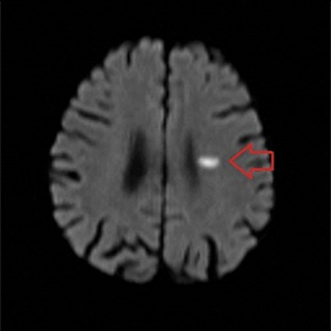 救急頭部MRIにおける急性期脳梗塞