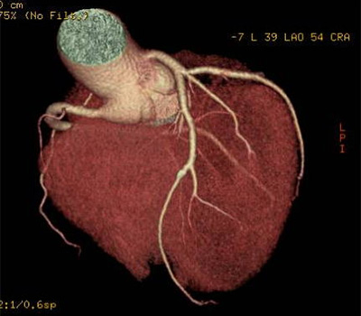 冠動脈3D画像(正常例)
