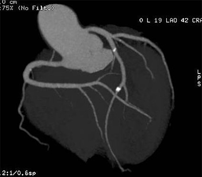 冠動脈MIP(最大値投影法)画像