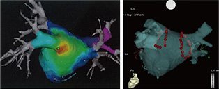 心房内マッピング