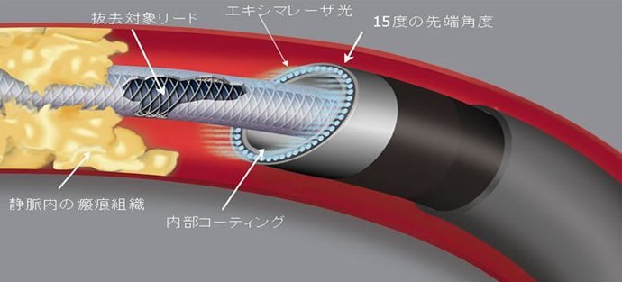 エキシマレーザーシステム