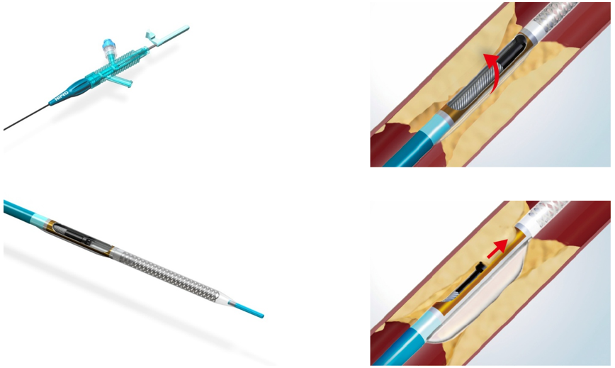 方向性冠動脈粥腫切除術(DCA)
