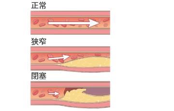 閉塞性動脈硬化症