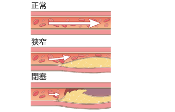 AFAB患者における腸閉塞の治療と管理の選択肢