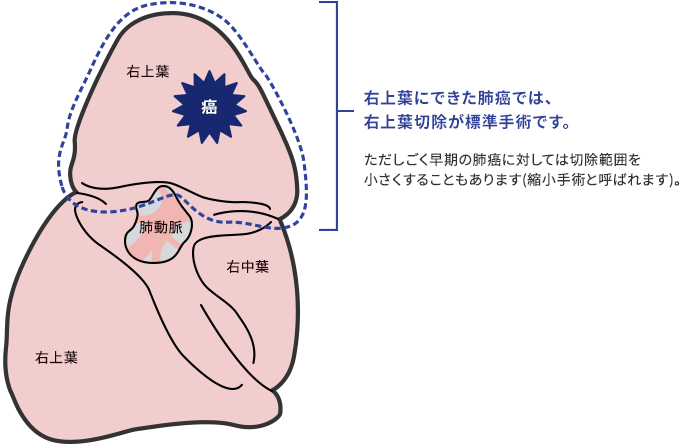 右上葉にできた肺癌では、右上葉切除が標準手術です。