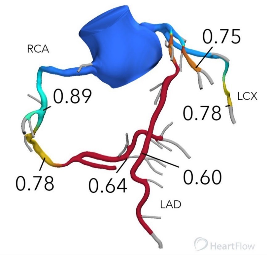 FFR-CT