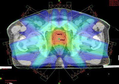 前立腺がんの強度変調放射線治療例