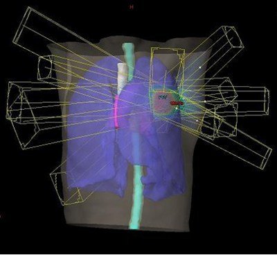 肺がんの体幹部定位放射線治療例