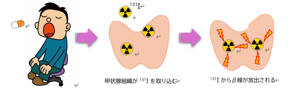 放射性ヨード治療の説明