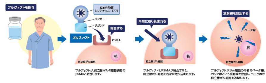 プルヴィクト治療-1