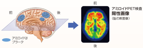 アミロイド検査陽性