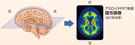 アミロイド検査陰性