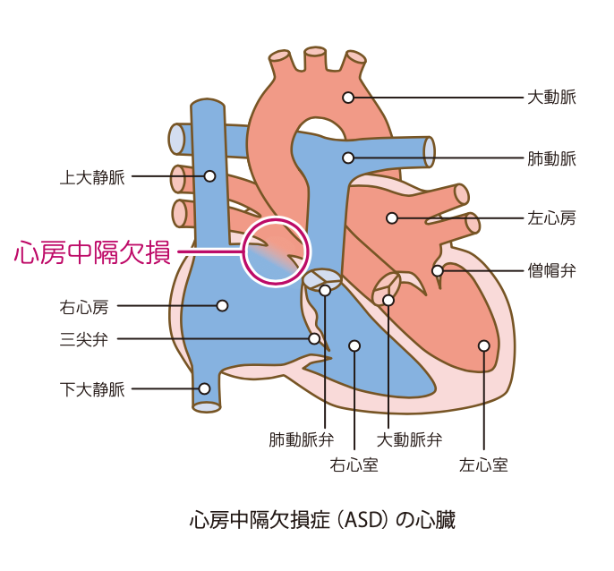 心房中隔欠損症(ASD)の心臓