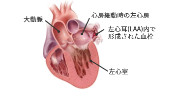 心房細動時の左心耳内血栓