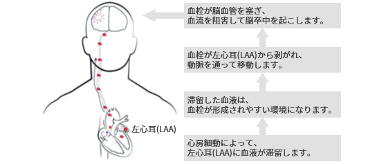 心房細動と脳卒中の関係