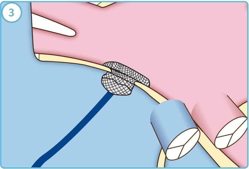 PFOカテーテル治療手順3