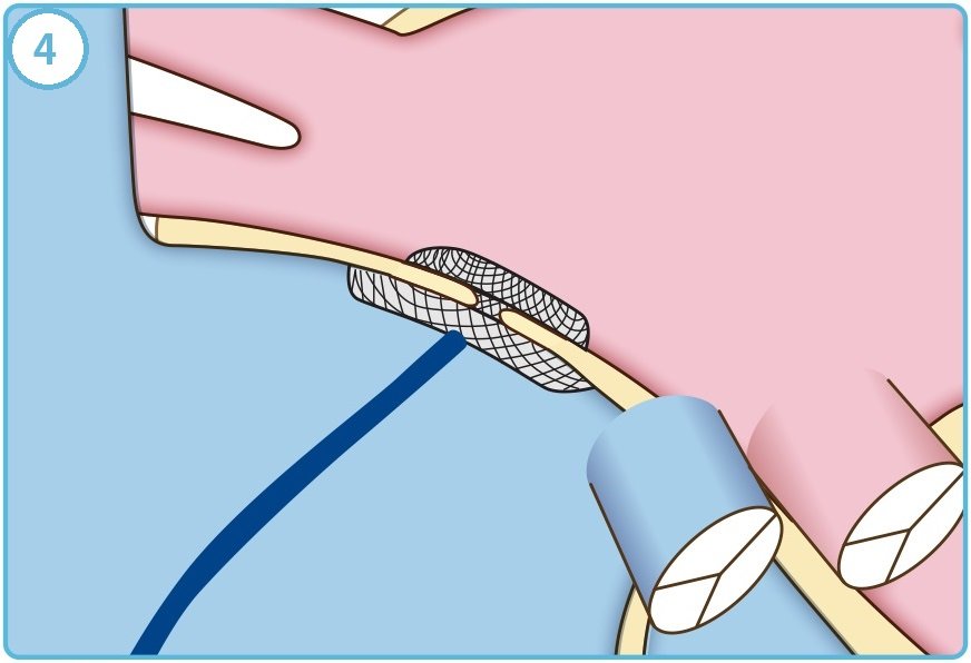 PFOカテーテル治療手順4