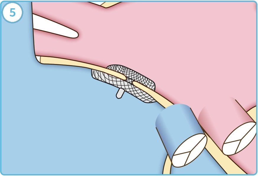 PFOカテーテル治療手順5