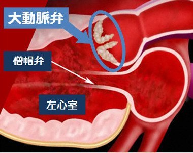 大動脈弁狭窄症とは