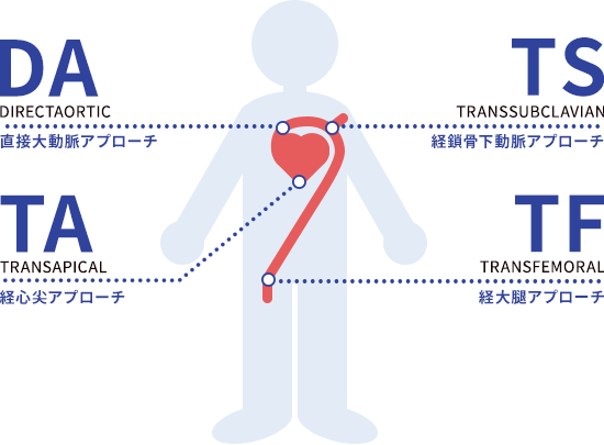 TAVIのアプローチ方法