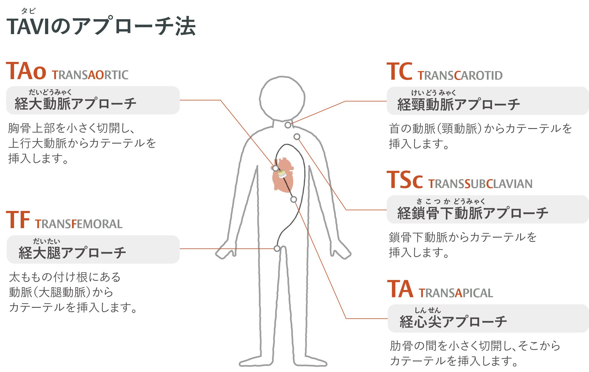 TAVIのアプローチ方法